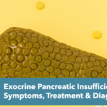 Exocrine Pancreatic Insufficiency